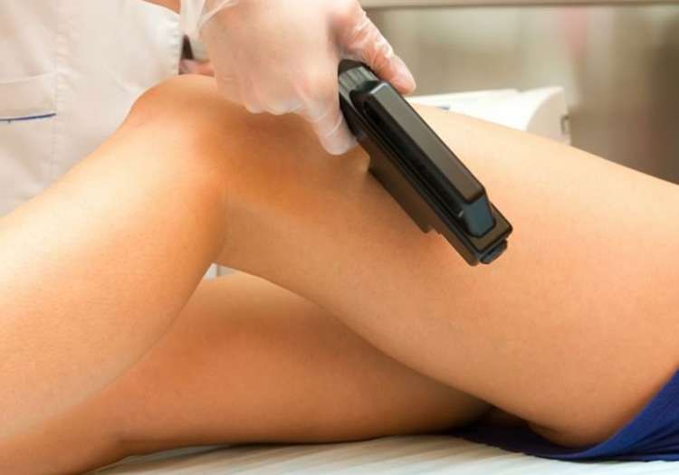 Epilazione Laser a Diodo